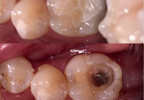 Hàn răng xong có ăn được không, cần kiêng gì không